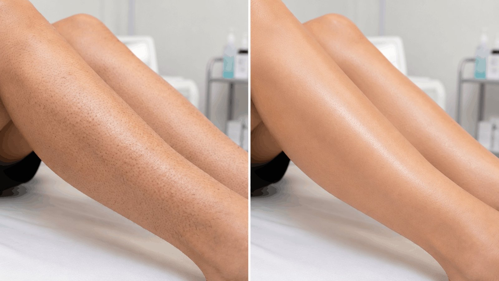 Legs before and after laser hair removal